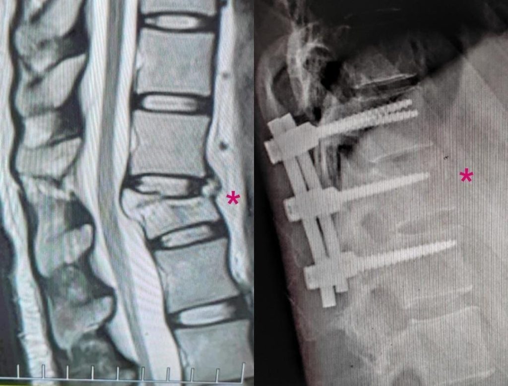 Vértebra quebrada x pinos nas costas da Jéssica